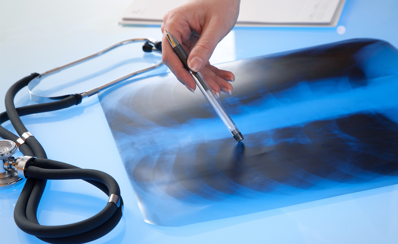 asbestosdisease