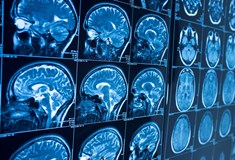 a series of brain scan images