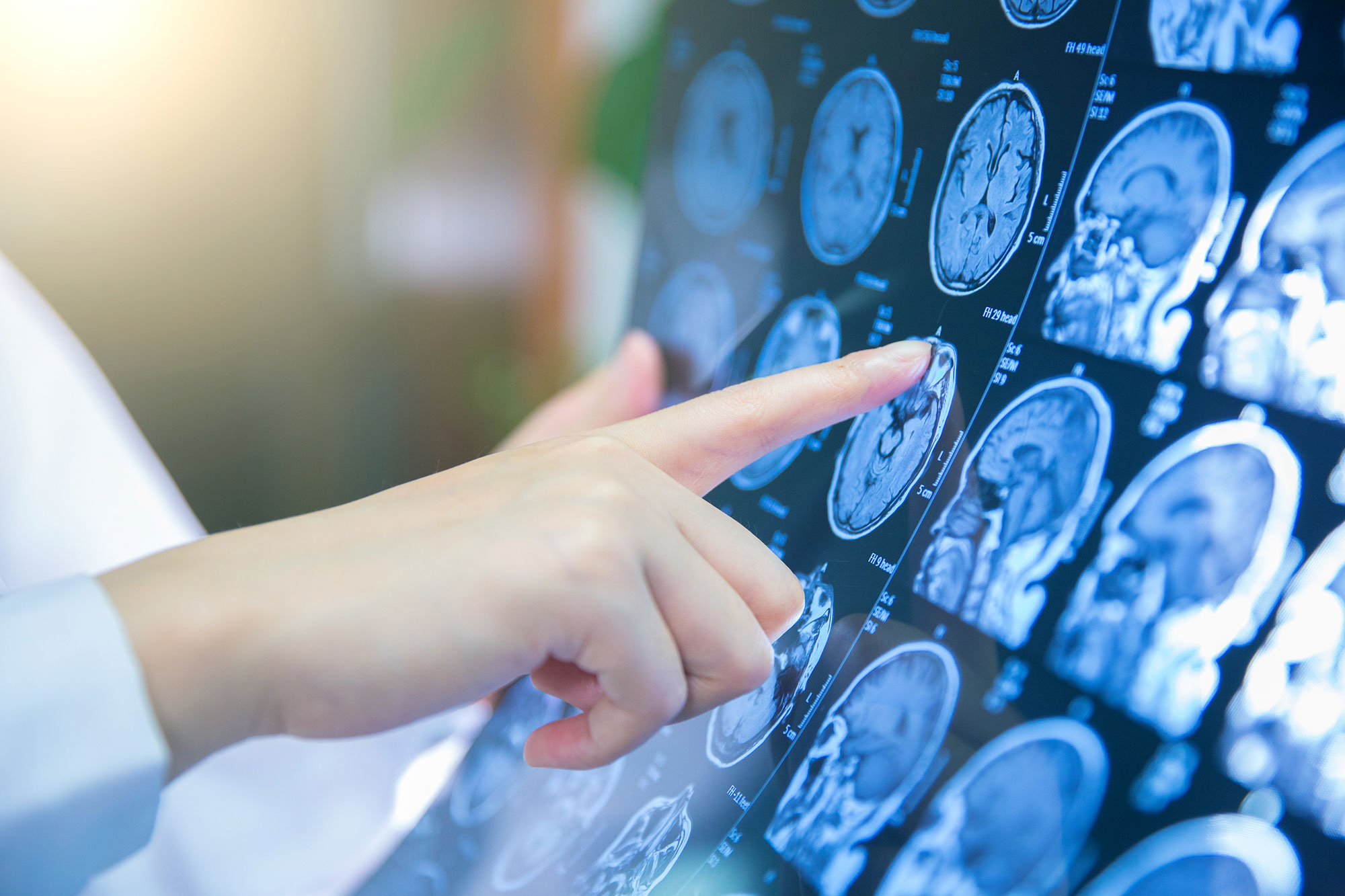 doctor looking at brain scan