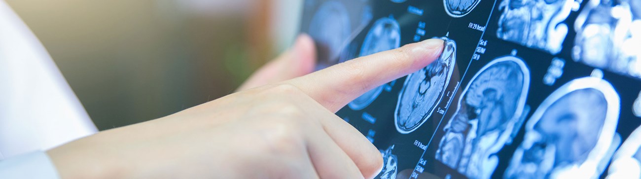 doctor looking at brain scan