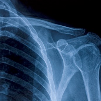 close up of shoulder X-ray