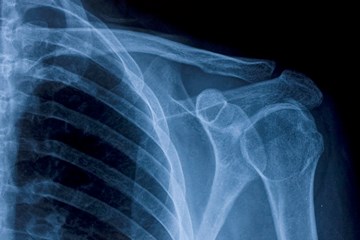 close up of shoulder X-ray